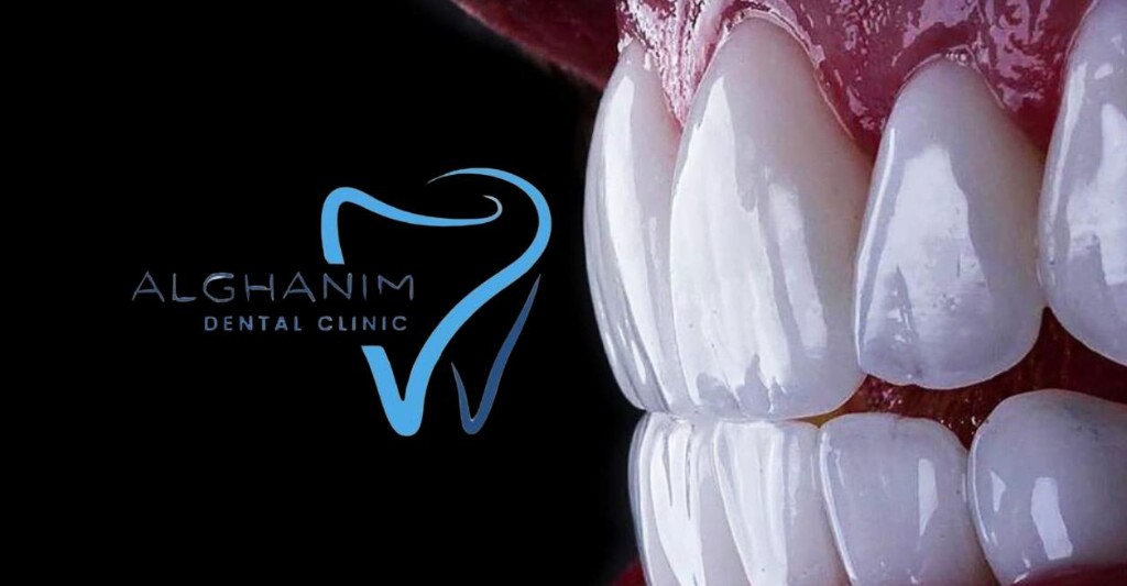 قشور السيراميك الزجاجي والإيماكس