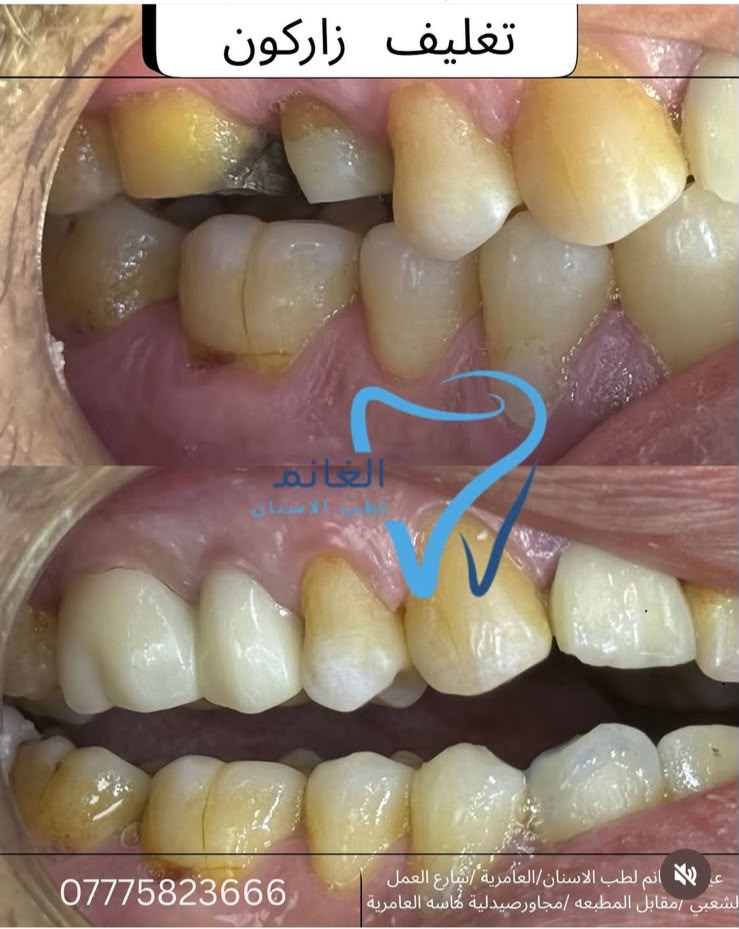 تغليف السن بالزيركون